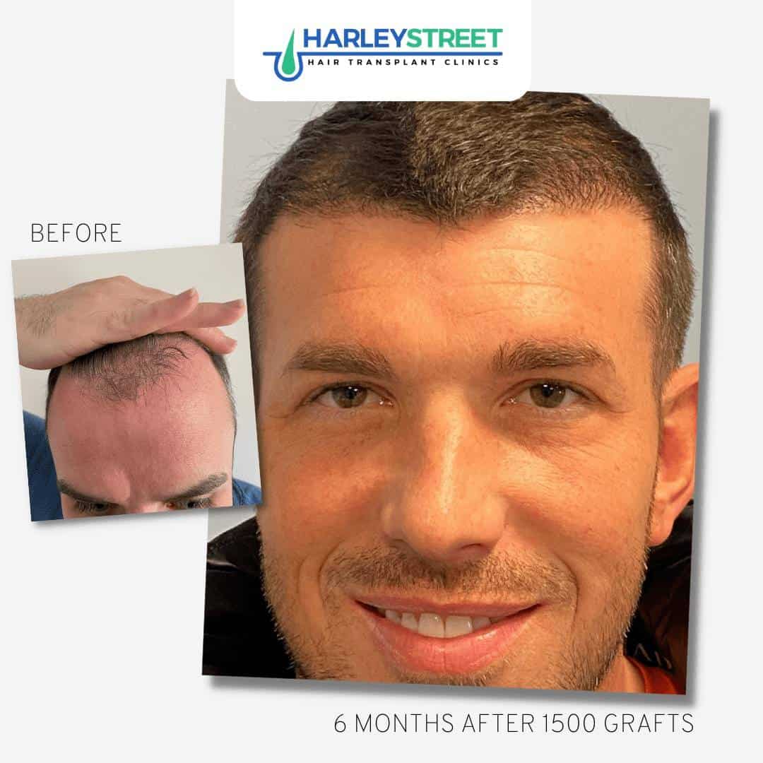 Hair Transplant Edinburgh Hair Loss Clinic in Edinburgh