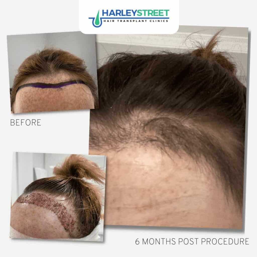 FUE-Female-Hair-Transplant-Before-and-After FUE-Female-Hair-Transplant-Before-and-After