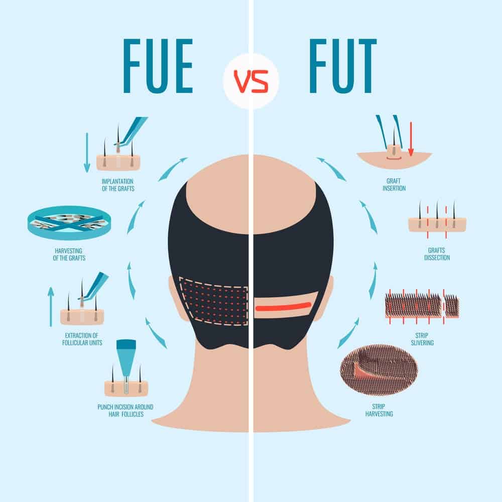 FUE vs FUT in hair transplant methods-min