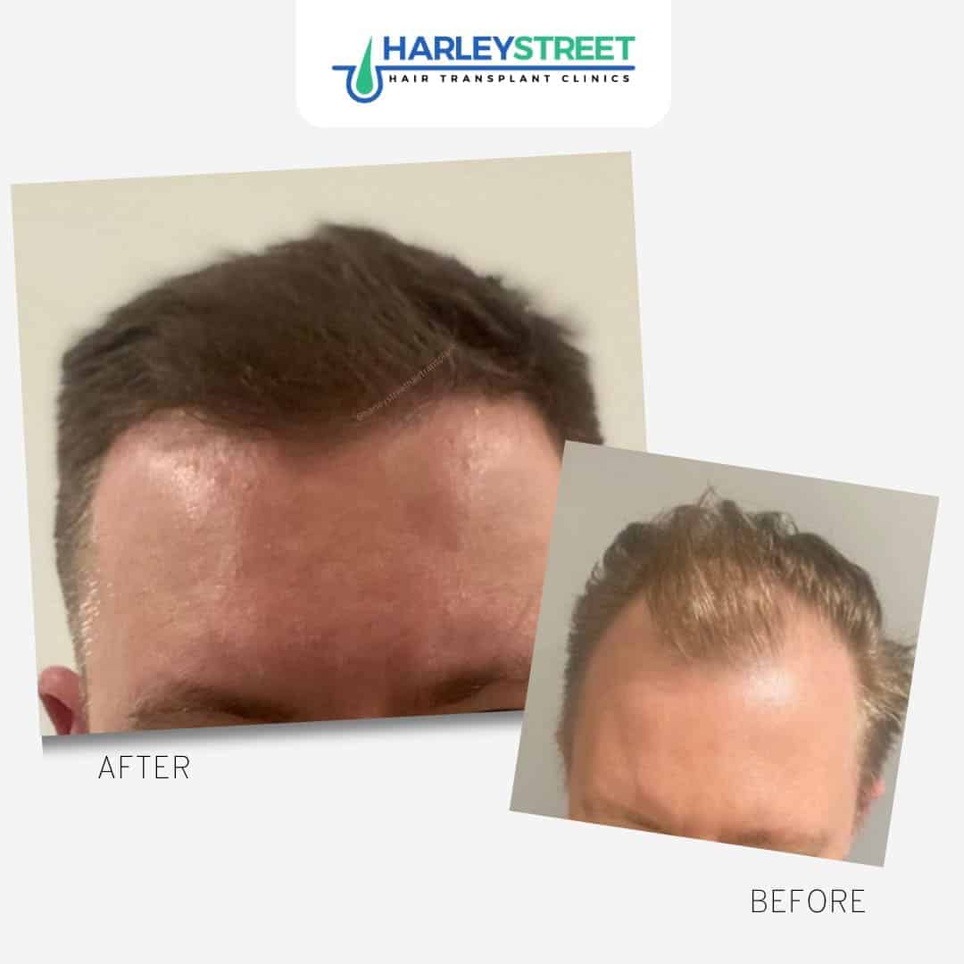 Hair Transplant Edinburgh Hair Loss Clinic in Edinburgh