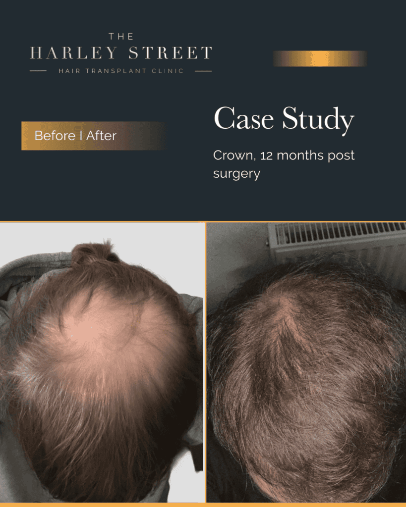 Crown Hair Transplant 1 Harley-Street-HT-pt-Wagstaff-crown-819x1024