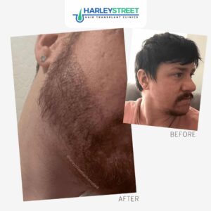 Harley-Street-Hair-Transplant-Clinics-Beard-transplant-patient-before-and-after