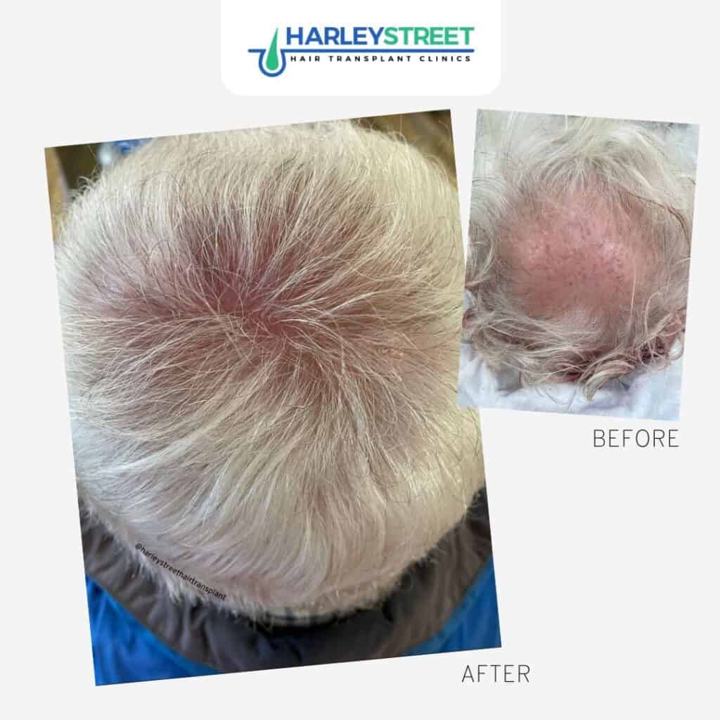 Harley Street Ht Clinics before and after crown older man