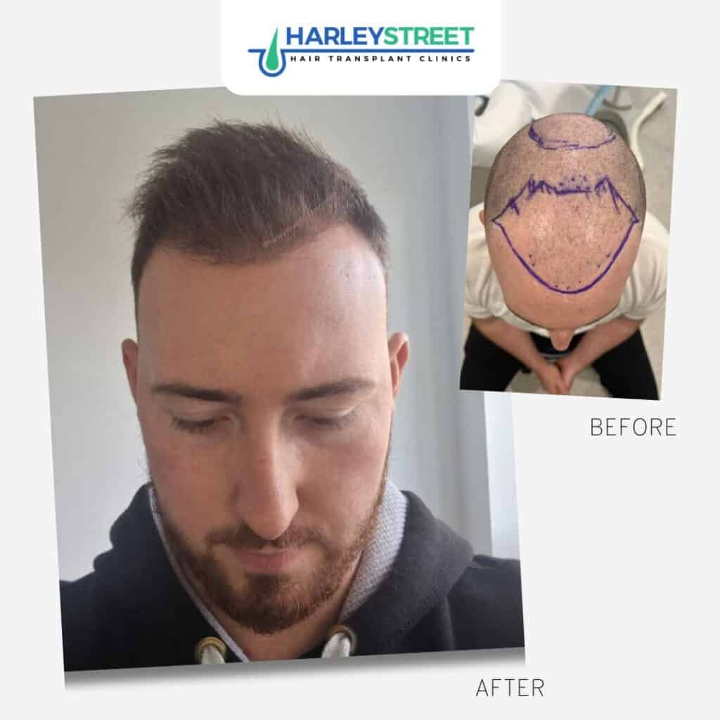 Free Consultation 2 Harley Street before and after hairline area