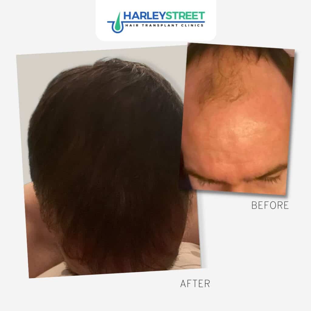 Harley Street before and after tom gibbs