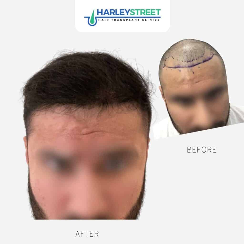 Shreyas Before & Afters