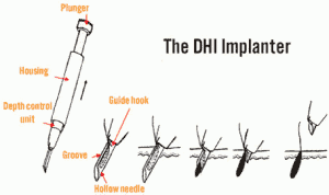 dhi-hair-transplant-method-tool-300x178